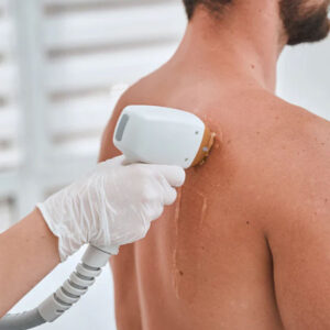 Full Back Laser Hair Removal