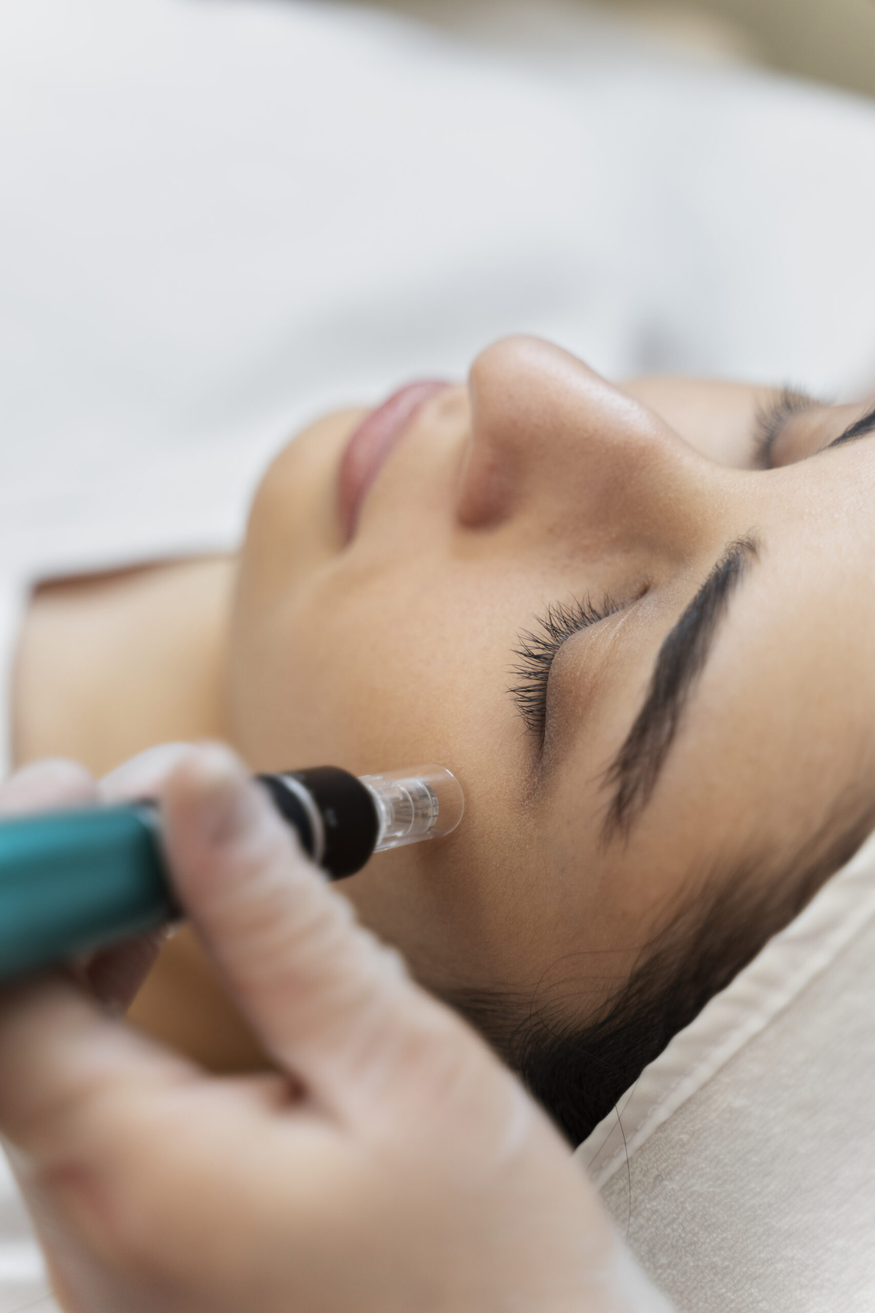 Microneedling treatment at Lium Laser & Med Spa in Sugar Land, TX